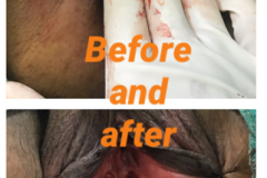 vaginoplasty-before-and-after-2