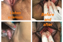 vaginoplasty-before-and-after