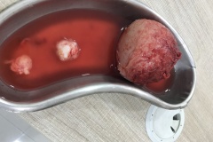 myomectomy-laparoscopy